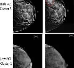 Experts use radiomics features to spot specific tissue patterns related to breast cancer.