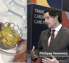 Philippe Genereux, MD, director of the structural heart program at Morristown Medical Center, principal investigator of the late-breaking EARLY TAVR trial, presented new data at ACC 2025 showing intervening earlier on patients with asymptomatic severe aortic stenosis leads to better outcomes. 