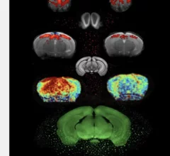 MRI biomarkers could signal early onset of Parkinson's.
