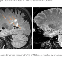 6-minute MRI can diagnose multiple sclerosis