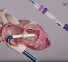 Topaz transcatheter tricuspid valve replacement (TTVR) system TriCares