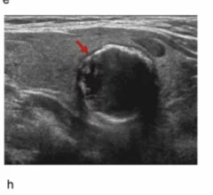 Predictive model helps identify malignancy in thyroid nodules.