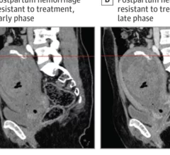 CT identifies postpartum hemorrhage resistant to treatment