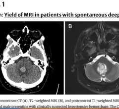 MRI may not be suitable for spontaneous deep ICH