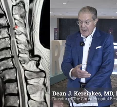 Dean Kereiakes, a nationally renowned interventional cardiologist and president of The Christ Hospital Heart and Vascular Institute, has long been recognized for his groundbreaking work in cardiovascular research and intervention. But in 2024, his career and his life were permanently altered when decades of wearing heavy lead protection in the cath lab left him paralyzed.