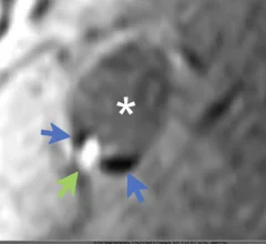 Calcified carotid plaques more likely to rupture than previously believed