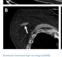 AI detects incidental breast lesions on routine CT scans