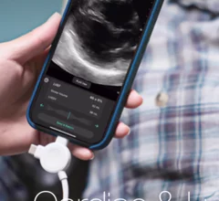 Exo Iris AI inks another FDA clearance for pleural effusion