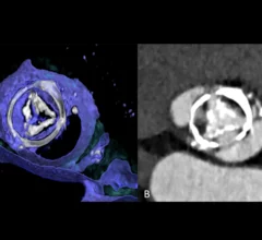 CT imaging showing structural valve deterioration 