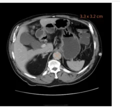 AI algorithm spots AAA on abdominal CT scan