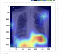AI spots fatty liver on chest x-rays.