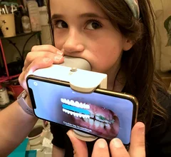 The AI enabled Dental Image Analyzer from DentalMonitoring uses a smartphone to scan a patient's mouth and the AI reconstructs a complete model of the mouth to compare with prior images to track the progress of orthodontic work at home. The FDA cleared the technology in cleared 2024. Photo by Dave Fornell Vivian Fornell