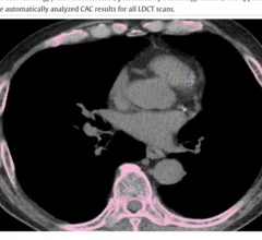 AI completes CAC assessment using routine LDCT scan