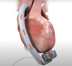 CorWave LVAD