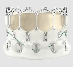 The balloon-expandable Myval transcatheter aortic valve replacement (TAVR) valve is associated with positive real-world data after four years.