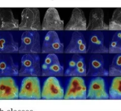 Explainable AI spots more cancer on breast MRI