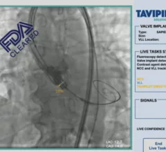 Caranx Medical TAVIPILOT