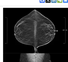 Lunit AI detects interval breast cancer missed by radiologists