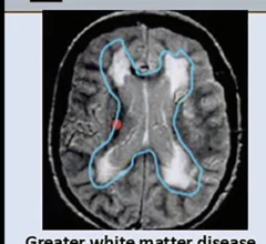 MRI biomarkers predict cognitive impairment post-stroke