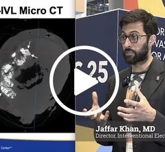 Video interview with Jaffar Khan, MD, St. Francis Heart Center, explaining tests using IVL in mitral annular calcification (MAC).