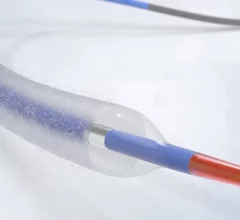 Boston Scientific said it initiated the AGENT DCB STANCE trial to assess the safety and effectiveness of the Agent Drug-Coated Balloon (DCB) compared to the standard of care using either percutaneous coronary intervention (PCI) with drug-eluting stents (DES) and/or balloon angioplasty. The trial will enroll more than 1,600 patients and is expected to a primary completion date in 2028. 
