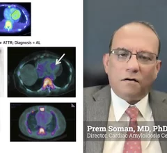 Prem Soman, MD, PhD, FACC, FRCP, past president of the American Society of Nuclear Cardiology (ASNC), the Richard S. Caligiuri Endowed Chair in Amyloidosis and Heart Failure, director of the Cardiac Amyloidosis Center, director of nuclear cardiology, and a professor of medicine, University of Pittsburgh Medical Center (UPMC) Heart and Vascular Institute. He is presenting the keynote Mario Verani Memorial Lecture at ASNC 2025, where he will discuss transforming cardiac amyloidosis care.
