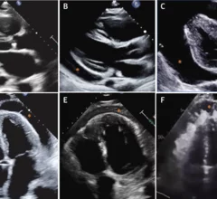 pericarditis cardiac imaging