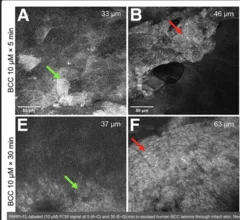 Fluorescent contrast agent helps diagnose basal cell carcinoma.