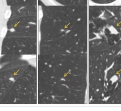 AI model reduces false positives on lung cancer CT scans