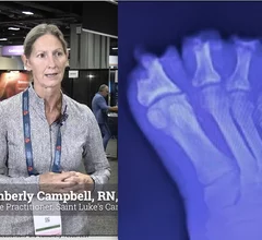 Kimberly Campbell, RN, ANP-BC, nurse practitioner, Saint Luke's Cardiovascular Consultants, explains how her health system took a heart team approach in its wound care transition program for peripheral artery disease (PAD) and critical limb ischemia (CLI) patients that lowered their amputation rate my more than 50%. 