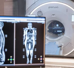 Prenuvo whole-body MRI