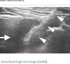 Ultrasound guidance a safer, more accurate method for biopsies of peripheral lung lesions in children