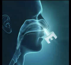 Corstasis Therapeutics bumetanide nasal spray Enbumyst