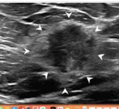Echogenic rinds on ultrasound may signal invasive cancer.