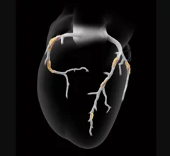 Heartflow Plaque Analysis