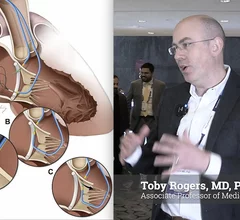 Toby Rogers, MD, PhD, associate professor of medicine Georgetown University, and interventional cardiologist at MedStar Heart and Vascular Institute Structural Heart Disease program, explains how the transcatheter electrosurgical procedures for transcaval access, SESAME, LAMPOON and BASILICA has helped large numbers of patients receive transcatheter heart valves who otherwise would have been disqualified due to anatomical issues. 