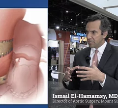 Ismail El-Hamamsy, MD, PhD, director of aortic surgery for the Mount Sinai Health System, explains the long-term outcomes of the Ross procedure, where a diseased aortic valve is surgically replaced with the patient's own pulmonary valve. 