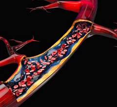 blood clot flow artery thrombectomy