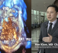 Dr. Nee Khoo, director of the echocardiography lab, Stollery Children’s Hospital, Edmonton, Canada, explains the rapidly growing adoption of pediatric 3D transesophageal echo (TEE) to not only preplan, but also guide and assess the results of congenital heart surgeries.