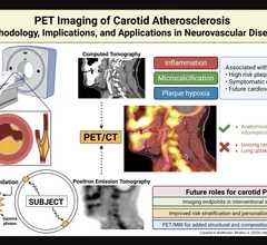 Positron emission tomography (PET) nuclear imaging has seen rapid expansion in cardiology and oncology due to its improve accuracy over SPECT and its ability to expand into new areas of cardiovascular imaging. A new review in the American Heart Association journal Stroke outlines another possible use of PET to assess carotid artery atherosclerosis for stroke prevention. Figure courtesy Stroke, https://www.ahajournals.org/doi/10.1161/STROKEAHA.125.050399