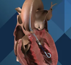 Impella CP Johnson & Johnson MedTech Abiomed