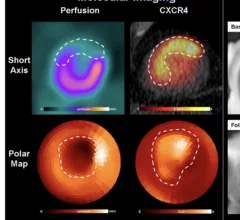 PET study targets inflammation to predict AMI recovery