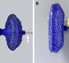 biodegradable PFO closure device