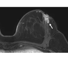 Pre-operative breast MRI improves outcomes in younger women with breast cancer