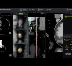 cvi42 | Plaque from Circle Cardiovascular Imaging