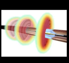 Paradise Ultrasound image courtesy of Recor Medical.