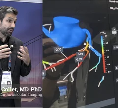 Carlos Collet, MD, PhD, director, cardiovascular imaging, physiology and translational therapeutics, Cardiovascular Research Foundation, explains how noninvasive coronary CT angiography (CCTA) assessments will play a major role to eliminate invasive diagnostic angiography and to pre-plan percutaneous coronary intervention (PCI) procedures.