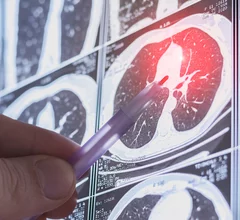 lung cancer screening low-dose CT