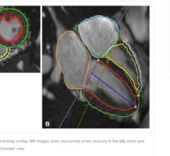 Right ventricle MRI marker independently predicts heart failure