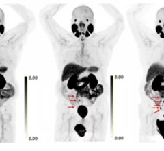 Copper-based radiotracer excels at PSMA imaging